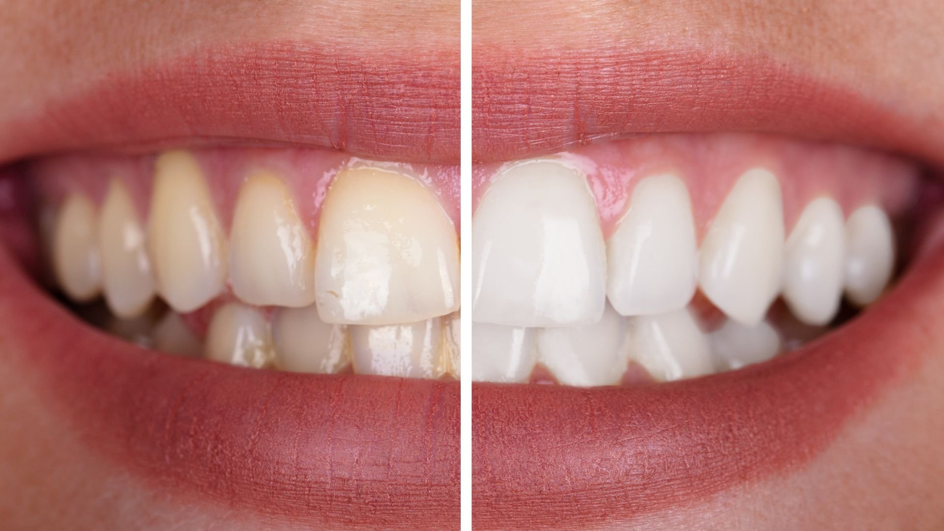 Before and after teeth whitening comparison showing dental transformation