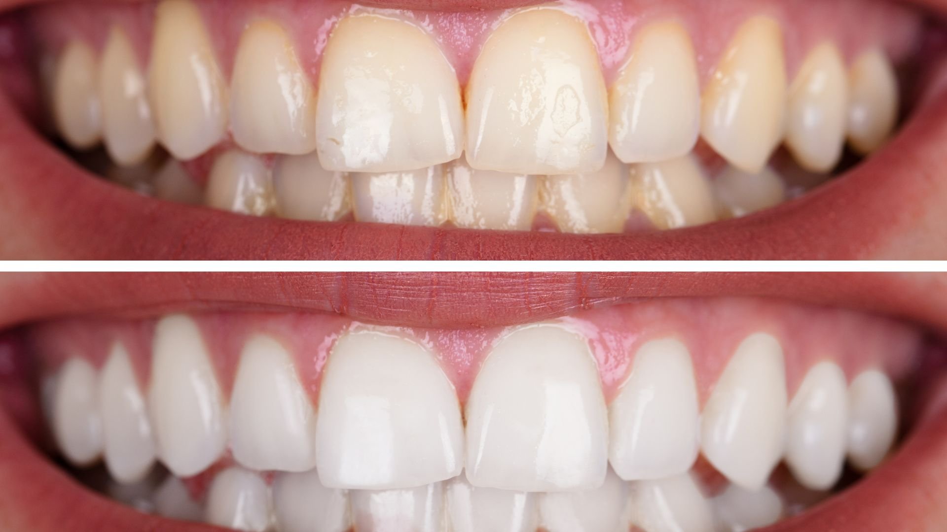 Teeth before and after whitening treatment, showing color transformation